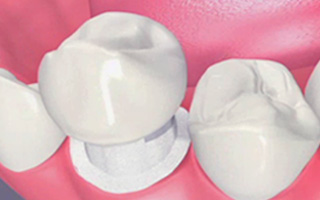 dental crowns