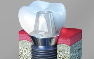 dental implants