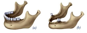 bonegrafting