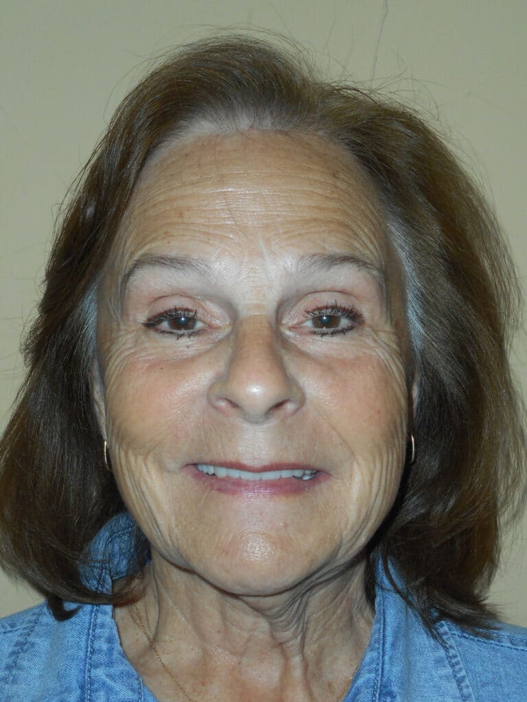After Image: Cosmetic Crowns and Veneers -