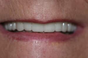 After Image: Cosmetic Crowns and Veneers