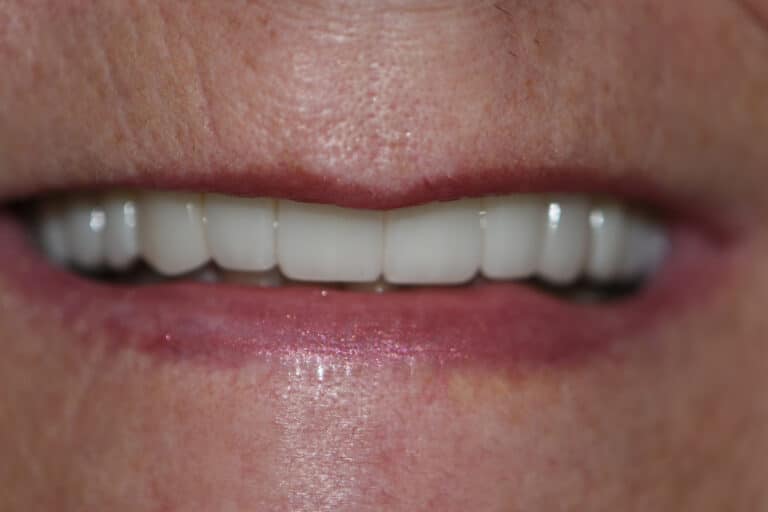 After Image: Cosmetic Crowns and Veneers - front