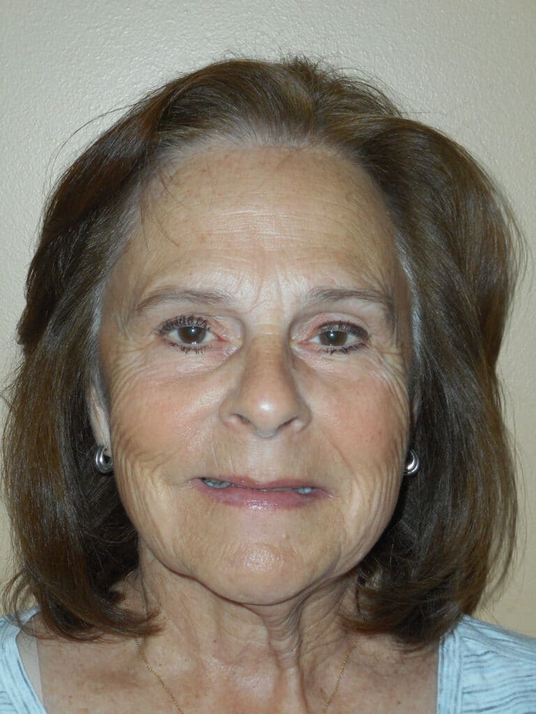 Before Image: Cosmetic Crowns and Veneers -