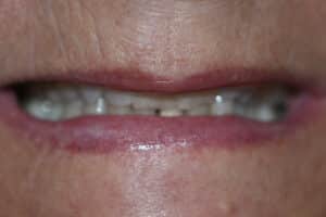Before Image: Cosmetic Crowns and Veneers