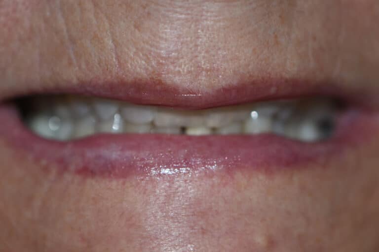 Before Image: Cosmetic Crowns and Veneers - front