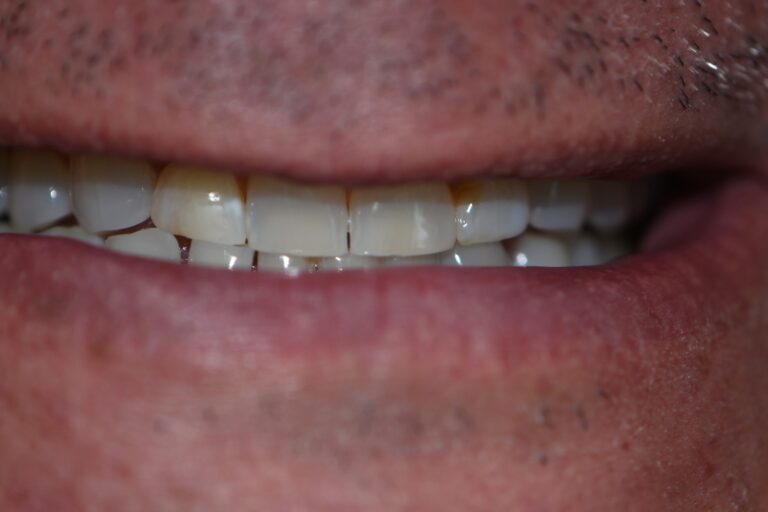 Before Image: Full Upper and Lower Crowns - front