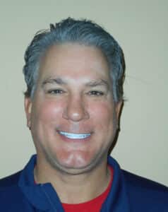 After Image: Full Upper and Lower Crowns