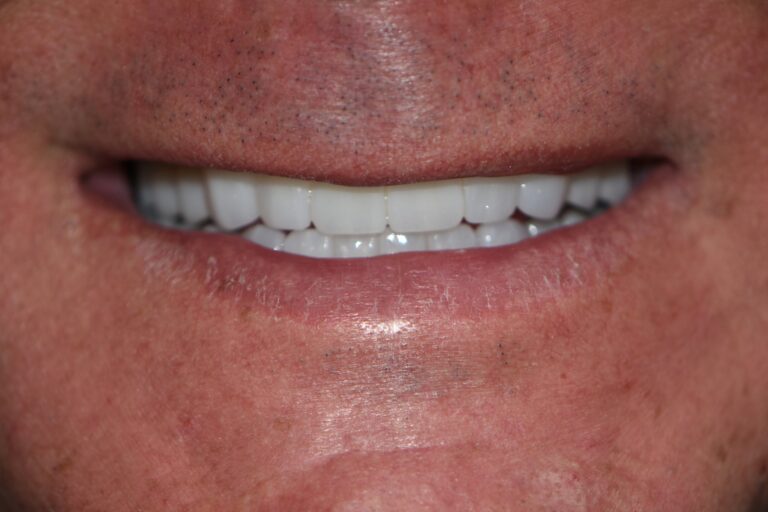 After Image: Full Upper and Lower Crowns - front