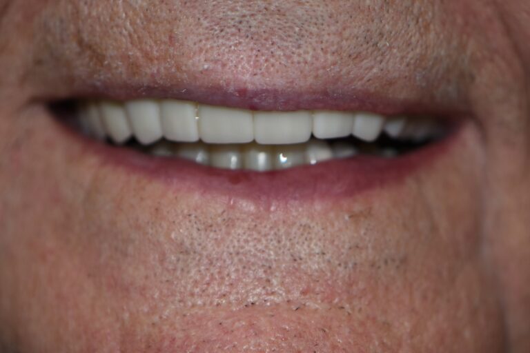 After Image: Upper Crowns - front