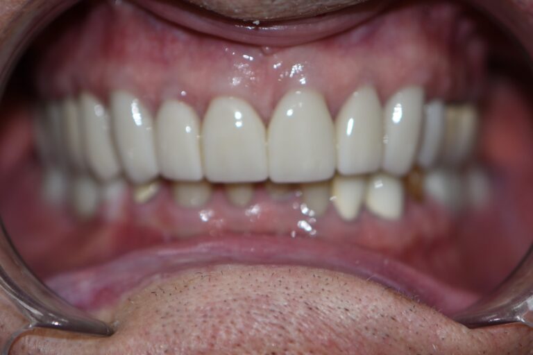 After Image: Upper Crowns -