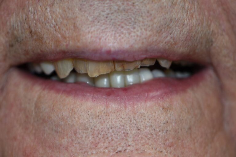 Before Image: Upper Crowns - front