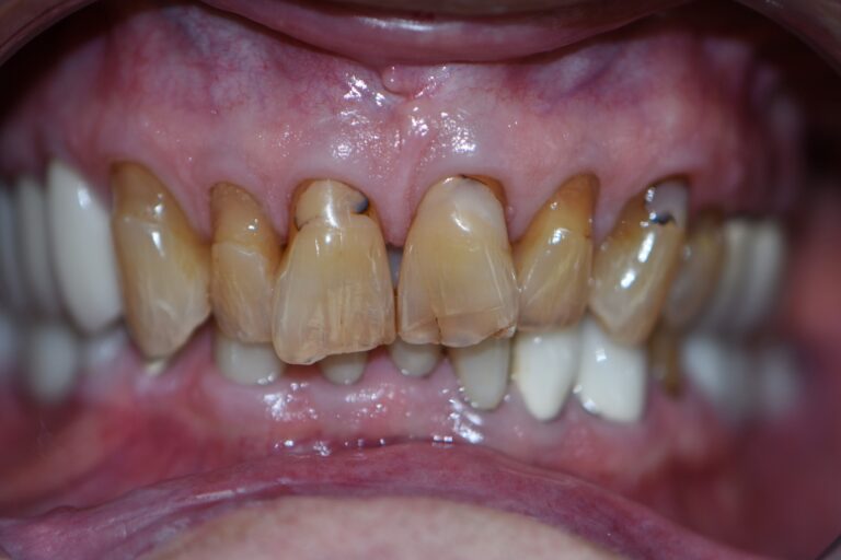 Before Image: Upper Crowns -