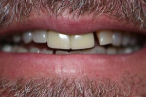 Before Image: Smile Makeover