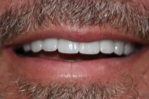 After Image: Smile Makeover