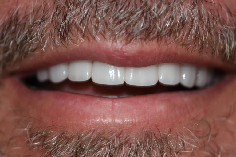 After Image: Smile Makeover - front